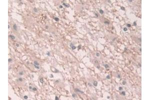 Detection of CX43 in Human Glioma Tissue using Polyclonal Antibody to Connexin 43 (CX43)