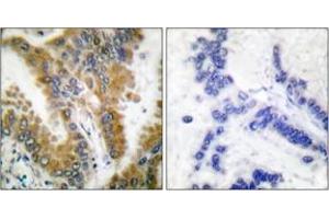 Immunohistochemistry analysis of paraffin-embedded human lung carcinoma tissue, using CrkL (Ab-207) Antibody.