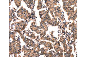 Immunohistochemistry of Human liver cancer using CGA Polyclonal Antibody at dilution of 1:65 (hCG anticorps)