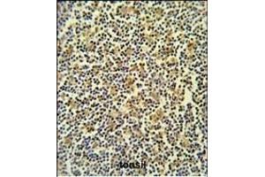 CORO6 Antibody (C-term) (ABIN651024 and ABIN2840040) IHC analysis in formalin fixed and paraffin embedded lymph carcinoma followed by peroxidase conjugation of the secondary antibody and DAB staining. (Coronin 6 anticorps  (C-Term))