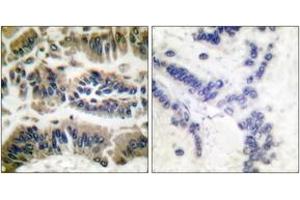 Immunohistochemistry analysis of paraffin-embedded human breast carcinoma tissue, using Caspase 6 (Ab-257) Antibody. (Caspase 6 anticorps  (AA 223-272))