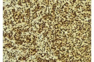 ABIN6274233 at 1/100 staining Human breast cancer tissue by IHC-P.