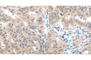 Immunohistochemistry of paraffin-embedded Human ovarian cancer tissue using SLC20A1 Polyclonal Antibody at dilution 1:40 (SLC20A1 anticorps)