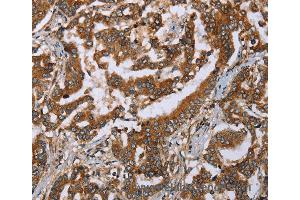 Immunohistochemistry of Human breast cancer using PLXNB1 Polyclonal Antibody at dilution of 1:50 (PLXNB1 anticorps)