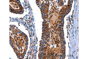 Immunohistochemistry of Human esophagus cancer using ITGA7 Polyclonal Antibody at dilution of 1:35 (ITGA7 anticorps)