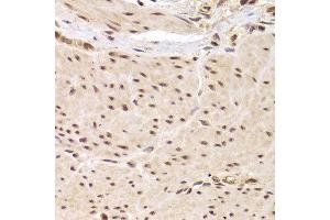 Immunohistochemistry of paraffin-embedded Human gastric cancer using RBPJ antibody at dilution of 1:100 (x40 lens). (RBPJ anticorps)
