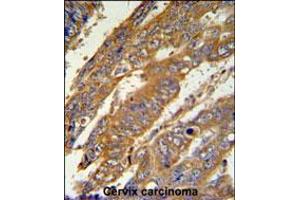 PAN3 Antibody IHC analysis in formalin fixed and paraffin embedded human cervix carcinoma followed by peroxidase conjugation of the secondary antibody and DAB staining.