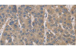 Immunohistochemistry of paraffin-embedded Human liver cancer tissue using IRAK4 Polyclonal Antibody at dilution 1:40 (IRAK4 anticorps)