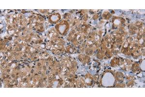 Immunohistochemistry of paraffin-embedded Human thyroid cancer tissue using LIMK1 Polyclonal Antibody at dilution 1:40 (LIM Domain Kinase 1 anticorps)