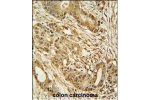 MCM2 Antibody (C-term) (ABIN653324 and ABIN2842815) immunohistochemistry analysis in formalin fixed and paraffin embedded human colon carcinoma followed by peroxidase conjugation of the secondary antibody and DAB staining. (MCM2 anticorps  (C-Term))
