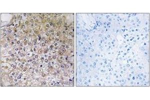 Immunohistochemistry analysis of paraffin-embedded human breast carcinoma tissue, using ATP6V1B1 Antibody. (ATP6V1B1 anticorps  (AA 381-430))