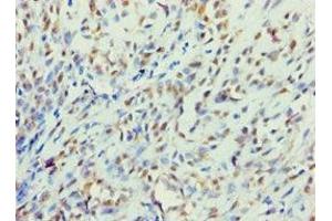 Immunohistochemistry of paraffin-embedded human breast cancer using ABIN7145241 at dilution of 1:100 (BBS4 anticorps  (AA 350-519))
