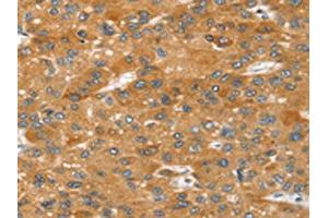 The image on the left is immunohistochemistry of paraffin-embedded Human liver cancer tissue using ABIN7192646(SRGAP2 Antibody) at dilution 1/20, on the right is treated with synthetic peptide. (SRGAP2 anticorps)