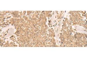 Immunohistochemistry of paraffin-embedded Human lung cancer tissue using IL1RAPL2 Polyclonal Antibody at dilution of 1:25(x200)