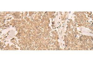 Immunohistochemistry of paraffin-embedded Human lung cancer tissue using IL1RAPL2 Polyclonal Antibody at dilution of 1:25(x200) (IL1RAPL2 anticorps)