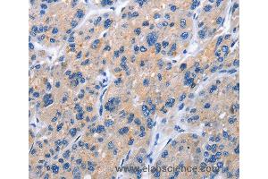 Immunohistochemistry of Human gastric cancer using TNFRSF9 Polyclonal Antibody at dilution of 1:40 (CD137 anticorps)
