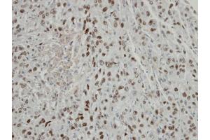 IHC-P Image Immunohistochemical analysis of paraffin-embedded Mahlavu xenograft, using COPS2, antibody at 1:100 dilution.