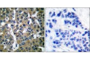 Immunohistochemistry analysis of paraffin-embedded human breast carcinoma tissue, using PLCG2 (Ab-753) Antibody. (Phospholipase C gamma 2 anticorps  (AA 721-770))