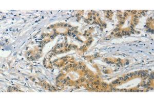 Immunohistochemistry of paraffin-embedded Human colon cancer tissue using ASB8 Polyclonal Antibody at dilution 1:50 (ASB8 anticorps)
