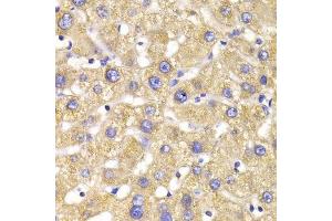 Immunohistochemistry of paraffin-embedded human liver injury using GPD2 Antibody.
