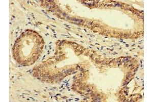 Immunohistochemistry of paraffin-embedded human prostate cancer using ABIN7165398 at dilution of 1:100
