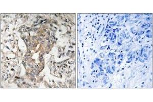 Immunohistochemistry analysis of paraffin-embedded human breast carcinoma tissue, using SPHK2 (Ab-614) Antibody.