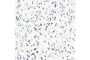 Immunohistochemistry of paraffin-embedded Human epithelioid sarcoma (ini-1 deletion) using SM/SNF5 antibody (ABIN7270657) at dilution of 1:1000 (40x lens).