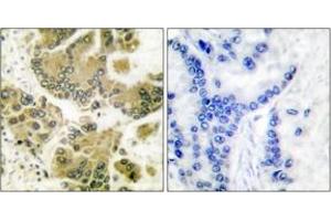 Immunohistochemistry analysis of paraffin-embedded human breast carcinoma tissue, using SGK (Ab-422) Antibody. (SGK1 anticorps  (AA 381-430))