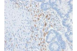IHC testing of FFPE human colon carcinoma with DC-SIGN antibody (clone C209/1781). (DC-SIGN/CD209 anticorps)