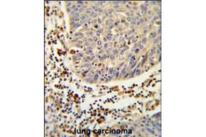Formalin-fixed and paraffin-embedded human lung carcinoma reacted with SH2D1B Antibody , which was peroxidase-conjugated to the secondary antibody, followed by DAB staining. (SH2D1B anticorps  (AA 65-92))