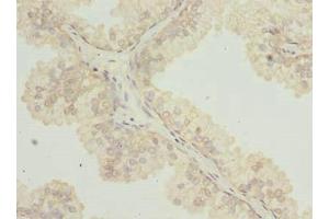 Immunohistochemistry of paraffin-embedded human prostate cancer using ABIN7171939 at dilution of 1:100 (TTC38 anticorps  (AA 2-200))