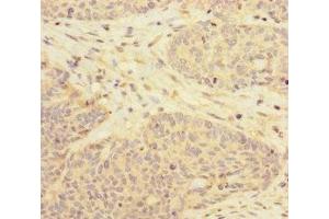 Immunohistochemistry of paraffin-embedded human ovarian cancer using ABIN7170629 at dilution of 1:100 (RBM17 anticorps  (AA 1-240))