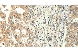 Immunohistochemistry of paraffin-embedded Human gastric cancer using TRPM5 Polyclonal Antibody at dilution of 1:60