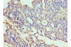 Immunohistochemistry of paraffin-embedded human endometrial cancer using ABIN7172022 at dilution of 1:100 (TXNRD2 anticorps  (AA 100-310))