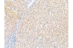 ABIN7094601 and ABIN7098651 at 1/100 staining Human liver cancer and adjacent normal tissues by IHC-P. (KCNK5 anticorps  (C-Term))