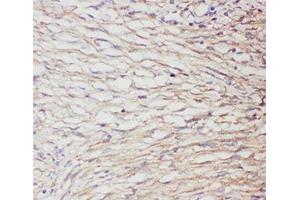 IHC-P: GFAP antibody testing of human brain cancer (GFAP anticorps  (AA 93-432))