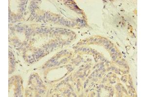 Immunohistochemistry of paraffin-embedded human breast cancer using ABIN7166957 at dilution of 1:100
