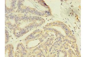 Immunohistochemistry of paraffin-embedded human breast cancer using ABIN7166957 at dilution of 1:100 (GDI2 anticorps  (AA 1-445))