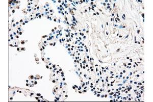 Immunohistochemical staining of paraffin-embedded Adenocarcinoma of breast tissue using anti-RAD9A mouse monoclonal antibody. (RAD9A anticorps)