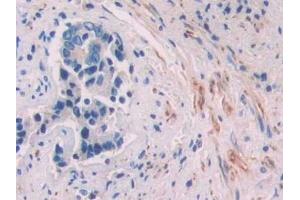 Detection of ACVR2A in Human Prostate cancer Tissue using Polyclonal Antibody to Activin A Receptor Type II A (ACVR2A)