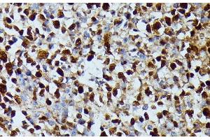 Immunohistochemistry of paraffin-embedded Human appendix using DUT Polyclonal Antibody at dilution of 1:100 (40x lens). (Deoxyuridine Triphosphatase (DUT) anticorps)