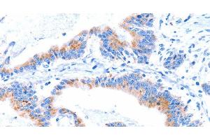 Immunohistochemistry of paraffin-embedded Human colon cancer tissue using SMG8 Polyclonal Antibody at dilution 1:50 (SMG8 anticorps)