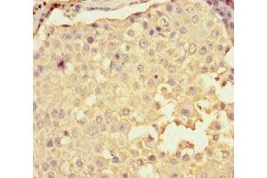 Immunohistochemistry of paraffin-embedded human breast cancer using ABIN7148515 at dilution of 1:100 (Copine II anticorps  (AA 1-300))