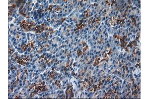 Immunohistochemical staining of paraffin-embedded Adenocarcinoma of colon using anti-KRT18 (ABIN2452646) mouse monoclonal antibody. (Cytokeratin 18 anticorps  (AA 69-372))