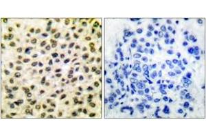 Immunohistochemistry analysis of paraffin-embedded human breast carcinoma tissue, using Fos Antibody.
