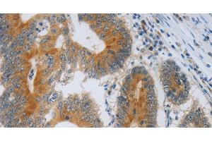 Immunohistochemistry of paraffin-embedded Human colon cancer using F2R Polyclonal Antibody at dilution of 1:40 (PAR1 anticorps)