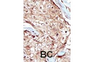 Formalin-fixed and paraffin-embedded human cancer tissue reacted with the primary antibody, which was peroxidase-conjugated to the secondary antibody, followed by AEC staining.
