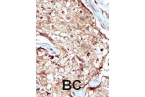 Formalin-fixed and paraffin-embedded human cancer tissue reacted with the primary antibody, which was peroxidase-conjugated to the secondary antibody, followed by AEC staining. (PAPSS2 anticorps  (C-Term))