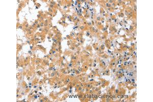 Immunohistochemistry of Human liver cancer using CDR2 Polyclonal Antibody at dilution of 1:60 (CDR2 anticorps)