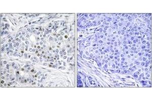 Immunohistochemistry analysis of paraffin-embedded human breast carcinoma tissue, using Retinoblastoma (Ab-821) Antibody. (Retinoblastoma Protein (Rb) anticorps  (AA 791-840))